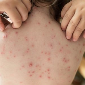 Half Of The Chickenpox Cases In The US May Not Be Chickenpox At All, New Study Reveals