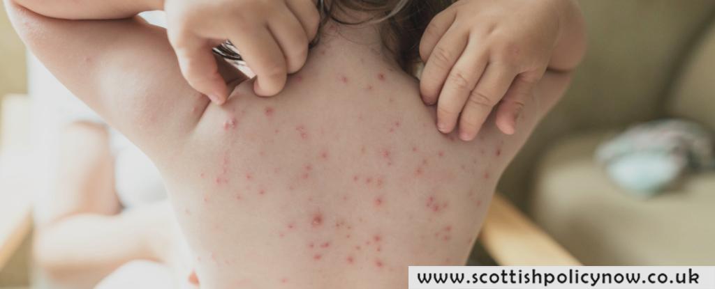 Half Of The Chickenpox Cases In The US May Not Be Chickenpox At All, New Study Reveals